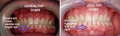 Gum Disease Cork City Dentist - Cork City Dentist