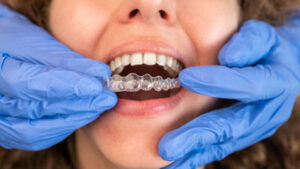Invisalign: How Often To Visit The Dentist